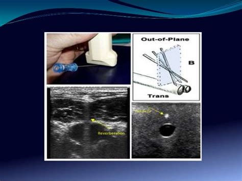 Ultrasound vascular access