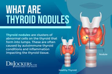 Thyroid Nodules: Symptoms, Causes, and Support Strategies