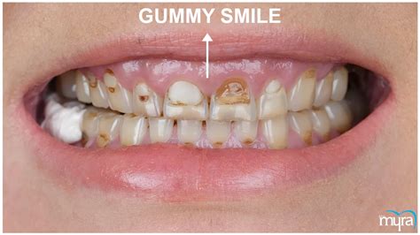 Gummy Smile: Definition, Types, Benefits, and Cost