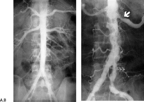 Atherosclerotic Aorta