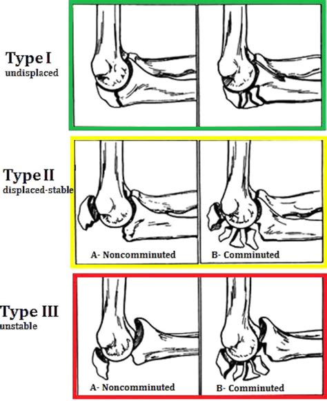 Olecranon fracture causes, symptoms, diagnosis, treatment & prognosis