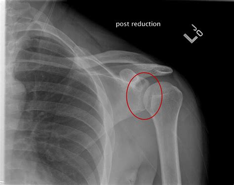 Shoulder Dislocation X Ray