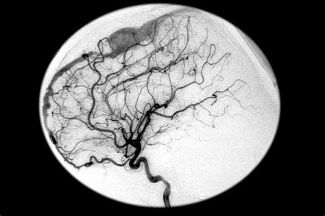 Site of Dural Arteriovenous Fistula Linked to Clinical Features of Headache - Neurology Advisor