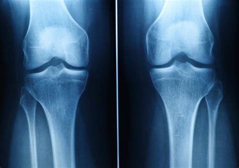 Can Stem Cells treatment Regrow the knee cartilage? - Global Stem Cells Group