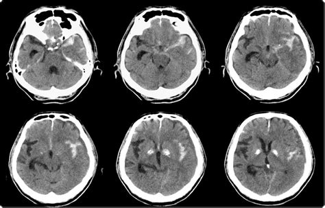 Lien causal fort entre le tabagisme et les saignements dans le cerveau