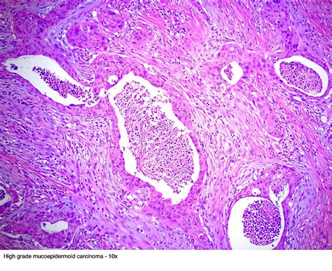 Pathology Outlines - Mucoepidermoid carcinoma