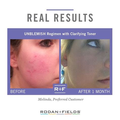 Review: Rodan + Fields Unblemish Regimen Skin Care Acne, Aging Skin ...