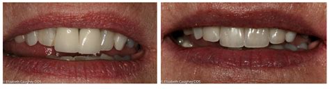 before and after porcelain crowns for teeth and implant - Elizabeth ...