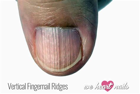 Vertical Ridges on Nails - Causes, Prevention & Treatment