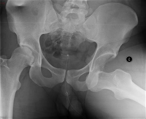 Posterior Hip Dislocation Presentation