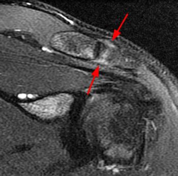 Acromioclavicular Joint Trauma - Radsource