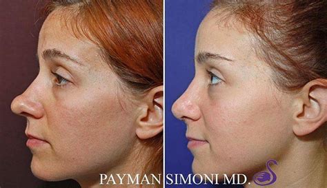 Bulbous Tip Rhinoplasty Before And After » Rhinoplasty: Cost, Pics ...