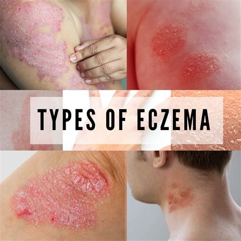 7 TYPES OF ECZEMA AND ITS SYMPTOMS - BANISH