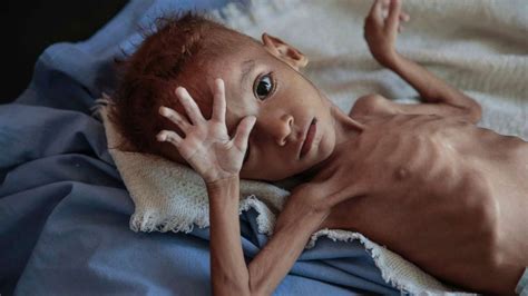 Hunger and Starvation Affecting Half the Human Race Across the Globe