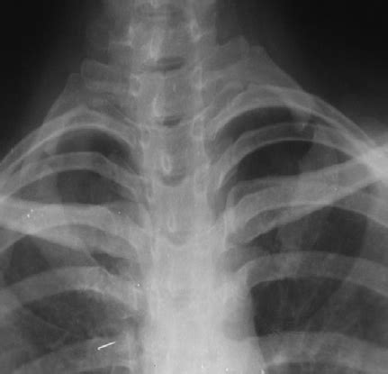 CT scan of the chest showing bilateral first rib fracture | Download Scientific Diagram