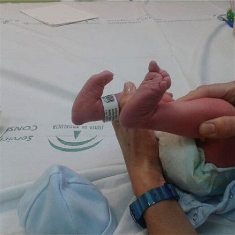 Newborn with bilateral congenital vertical talus | Download Scientific ...