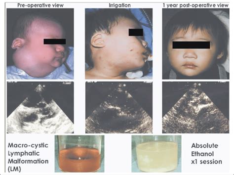 A patient with macrocystic lymphatic malformation (LM). | Download ...