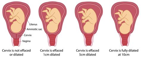 Dilated Cervix Diagram