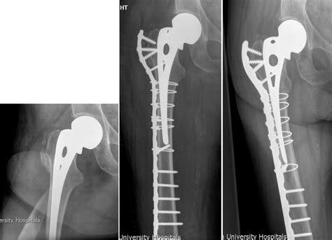 Periprosthetic fractures around hip hemiarthroplasty performed for hip fracture - Injury