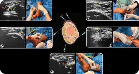 Anatomical, ultrasound and clinical images of ankle block procedures,... | Download Scientific ...