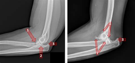 Ulna Fracture Near Elbow