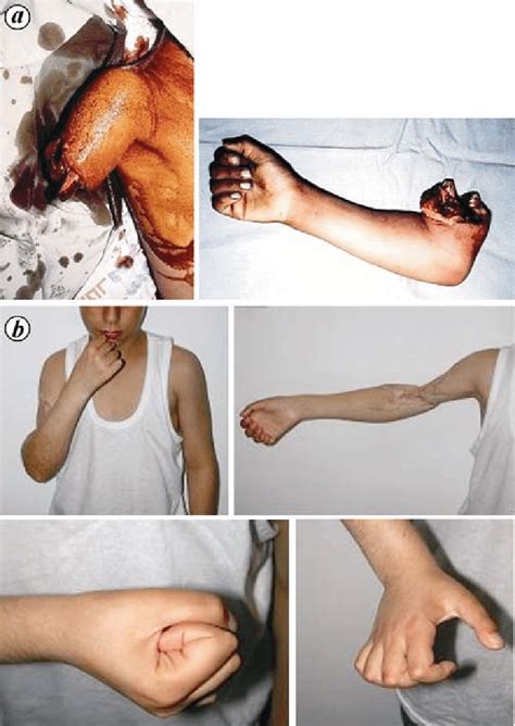 (a) 8 years old boy with type 2 amputation above elbow (b) functional... | Download Scientific ...