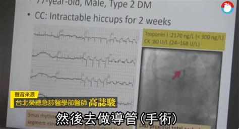 77yo Man Had Non-Stop Hiccups for 2 Weeks, Dies After Being Diagnosed ...