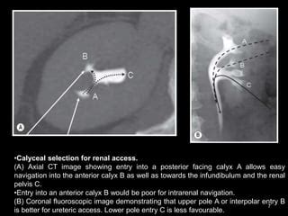 Percutaneous nephrostomy | PPT