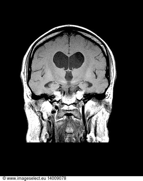 MRI Communicating Hydrocephalus (NPH) MRI Communicating Hydrocephalus ...