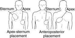 Anteroposterior Aed Placement