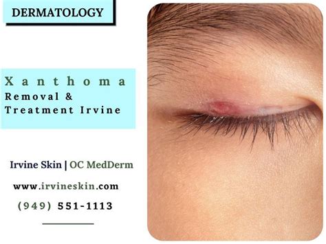 Xanthoma Removal Irvine & Orange County | Dermatology, Radio frequency, Skin