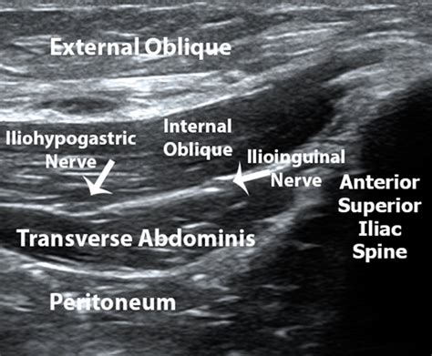 Ilioinguinal Nerve Block Ultrasound