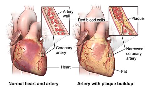 Coronary Artery Bypass Graft Surgery | Johns Hopkins Medicine