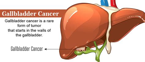 How To Prevent Gallbladder Cancer - Amountaffect17