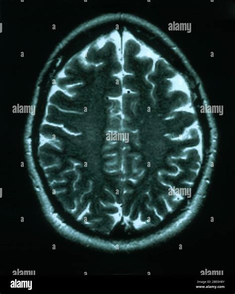 MRI scan, T2 weighted, axial view through the brain of a 54 year old female. The MRI is normal ...