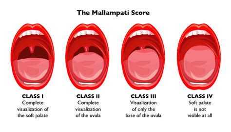 The Mallampati Score | West Chester, PA Sleep Dentist