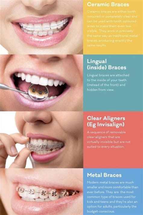 Pin by American Braces & Smile Center on Braces Types | Straighten ...