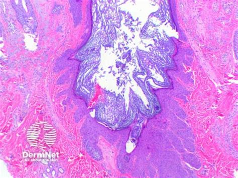 Dilated pore of Winer pathology