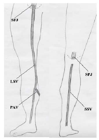 RadiologySpirit: surgical anatomy of saphenous veins