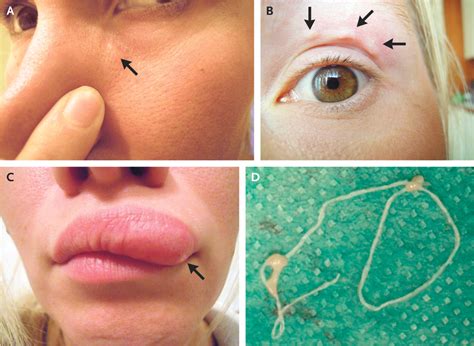 Lump On Woman's Face Turns Out To Be A Parasite Crawling Under Her Skin - MEDizzy Journal