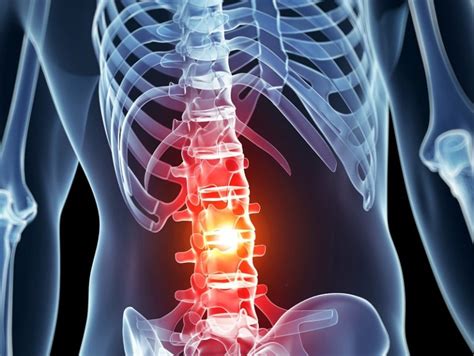 Causes of spinal cord injuries