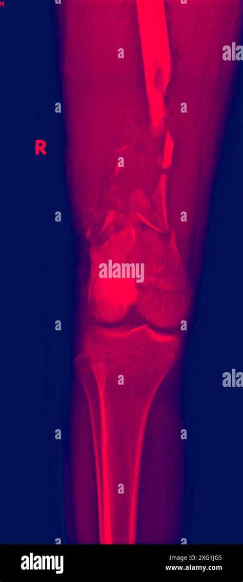 Coloured X-ray of a comminuted femur (thigh bone) fracture. This is a type of fracture in which ...