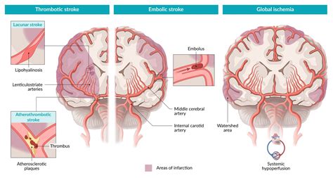 Lacunar Stroke Syndromes