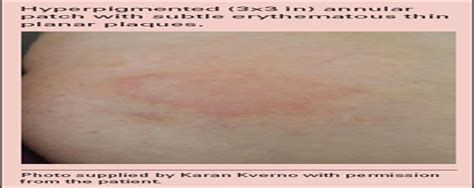 Lamotrigine rash: Benign allergy or severe adverse reaction? : The Nurse Practitioner