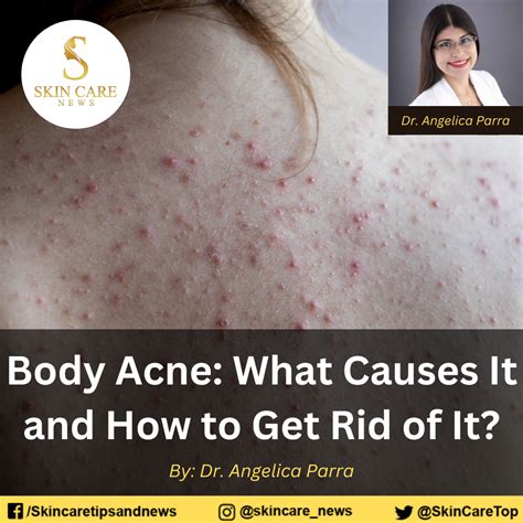 Body Acne: What Causes It and How to Get Rid of It?