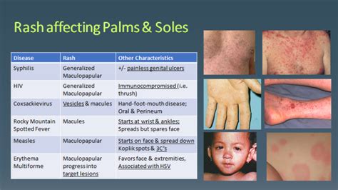 Rash affecting palms & soles… Secondary syphilis | SCVMC IM Chief ...