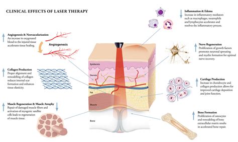 How Does Laser Therapy Work? - Vitality Depot