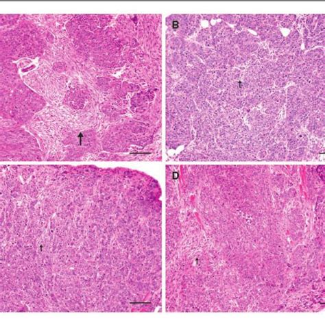 Desmoplasia in s.c. human epithelial ovarian carcinomas. H&E staining... | Download High-Quality ...