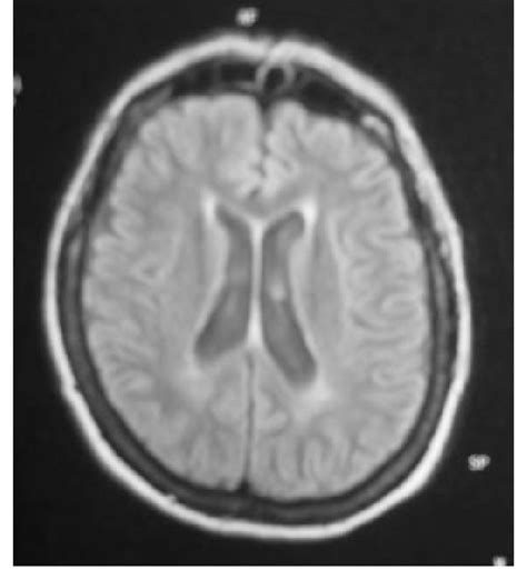 Brain MRI on flair-weighted image. Periventricular white matter high... | Download Scientific ...