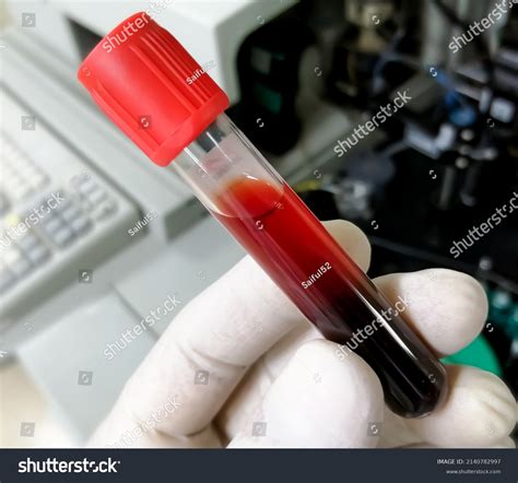 205 Hemolytic Sample Images, Stock Photos & Vectors | Shutterstock